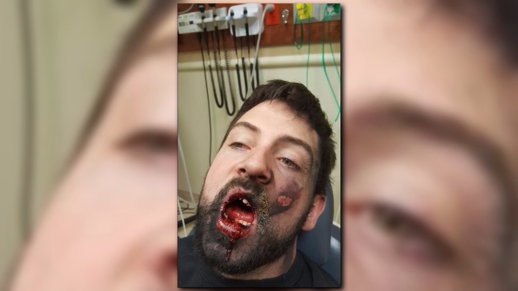 GRAPHIC IMAGES Man hospitalized after vape pen allegedly explodes